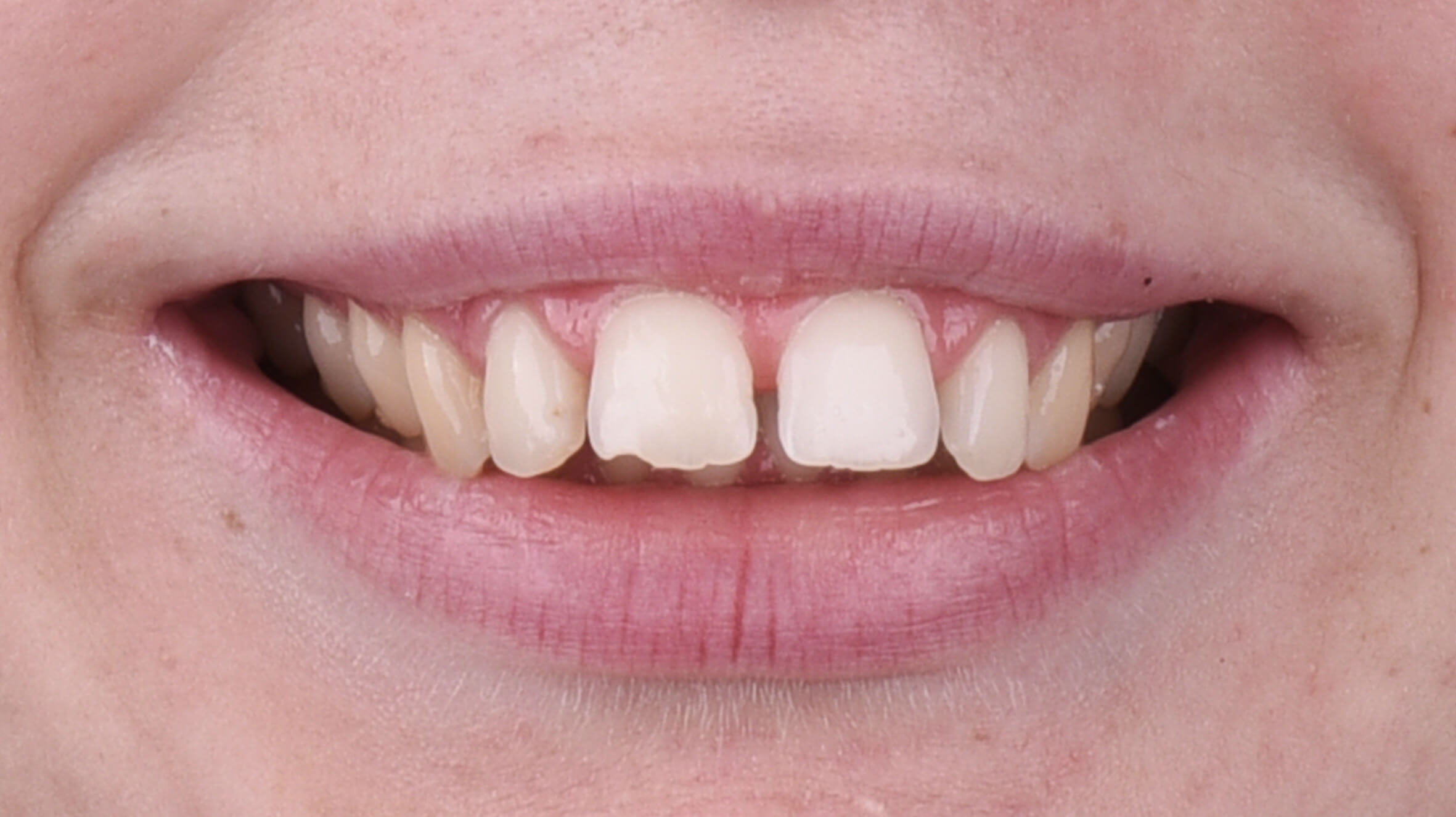 Sorriso antes do tratamento ortodôntico